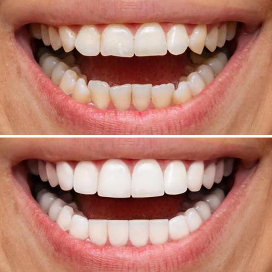 Veneers